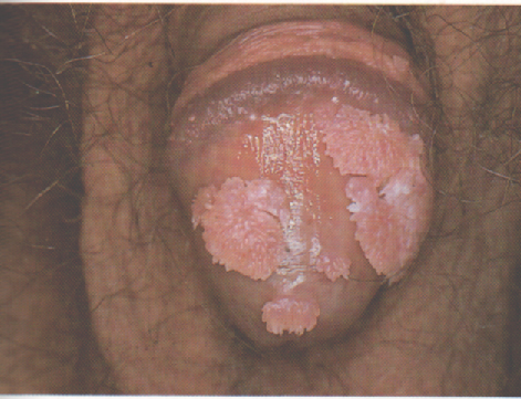 penis cu gonoree